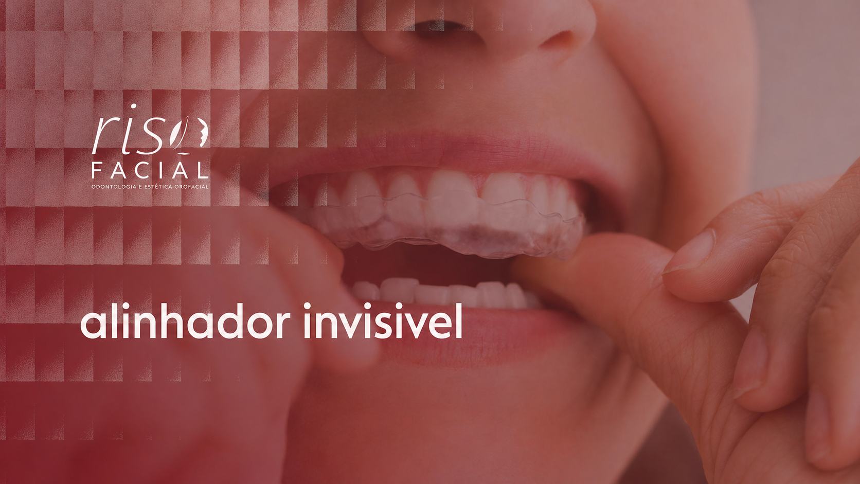 Imagem ilustrativa sobre alinhador invisivel